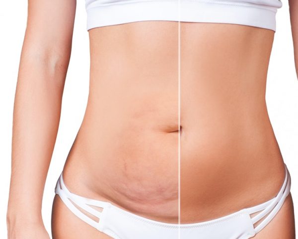 dos-and-donts-after-tummy-tuck